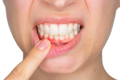 woman indicates receding gums